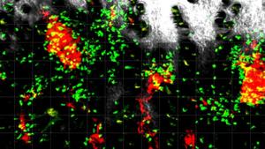 CD4+ T cells attacking melanoma cells in the skin.