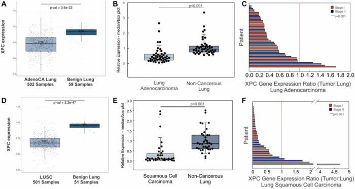 Cigarette smoke and decreased DNA repair by Xeroderma Pigmentosum Group C use a double hit mechanism for epithelial cell lung carcinogenesis