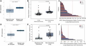 Cigarette smoke and decreased DNA repair by Xeroderma Pigmentosum Group C use a double hit mechanism for epithelial cell lung carcinogenesis