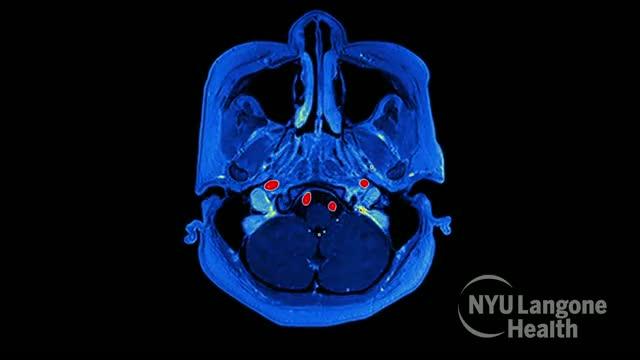 Experimental AI Tool Recognizes PTSD Based on Voice Features