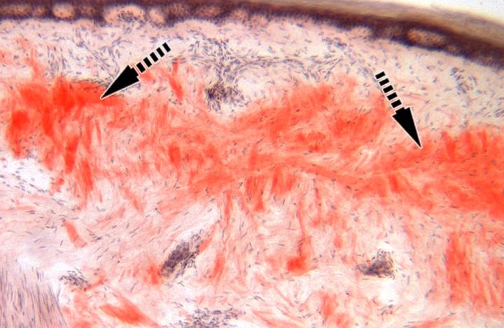 Amyloidosis