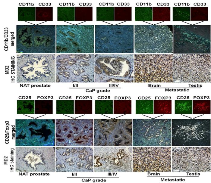 Targeting MD2 in prostate cancer bone metastasis: Mechanistic insights and therapeutic potential