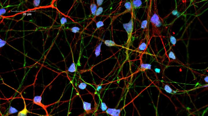 Neurons and Stem Cells in Patients with CS