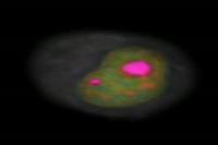 Metastatic Carcinoma Mammary Epithelial Cell Nucleus