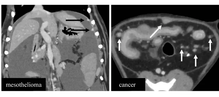 CT imaging findings