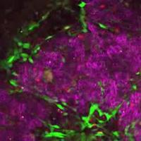 Active (Green) Cancer Cells Spreading