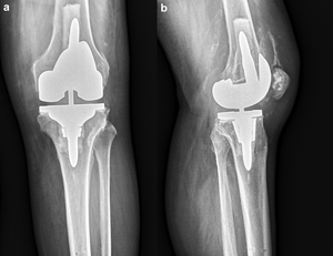 Case 2 Post-TKA