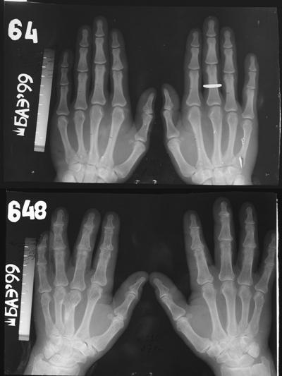 Bones and Aging