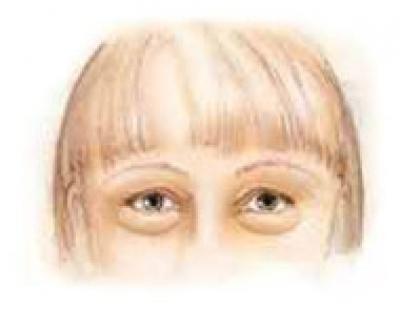 Baggy Eyelids