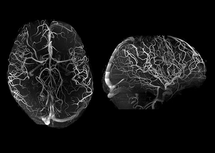 7T Angiography
