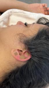 Could acupuncture to the ear help to relieve migraines?