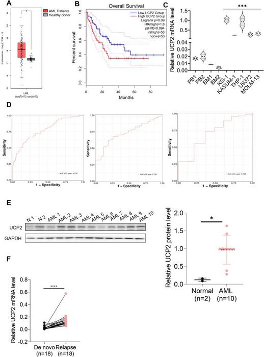 UCP2 acts as a potential prognostic marker in AML.