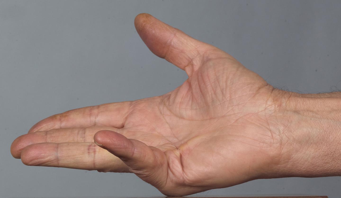 Dupuytren's Contracture