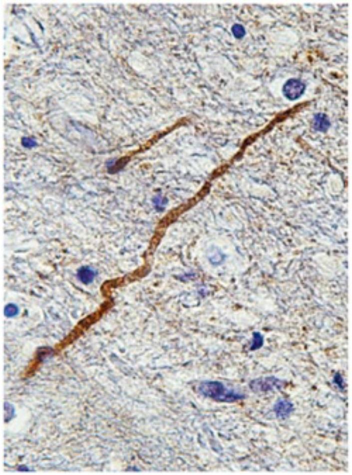 Brain Injury