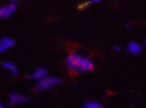 In red, Bacteroides, one of the microorganisms identified in this work, inside nucleus of a pancreatic cell, in blue