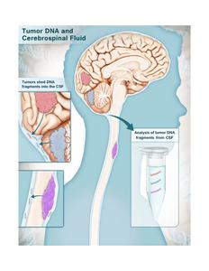 brain cancer