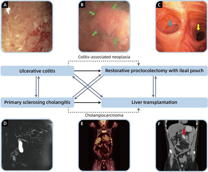 Association between primary sclerosing cholangitis and ulcerative colitis.