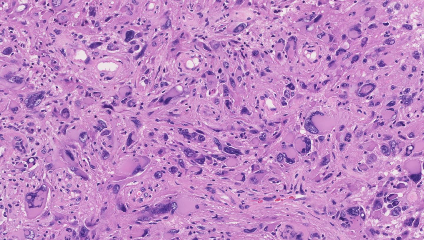 Glioblastoma Cells