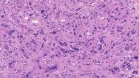 Glioblastoma Cells