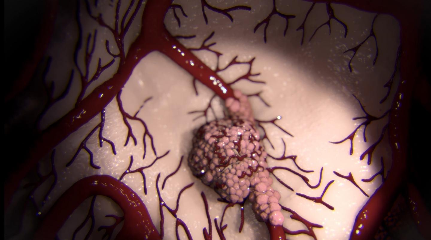 Primary Tumor