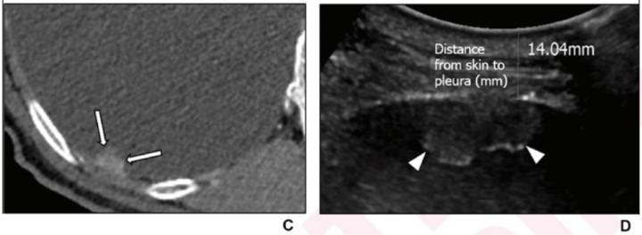 84-Year-Old Man Diagnosed with Pleural Metastasis From Lung Adenocarcinoma on US-Guided PCPNB