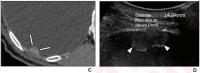 84-Year-Old Man Diagnosed with Pleural Metastasis From Lung Adenocarcinoma on US-Guided PCPNB