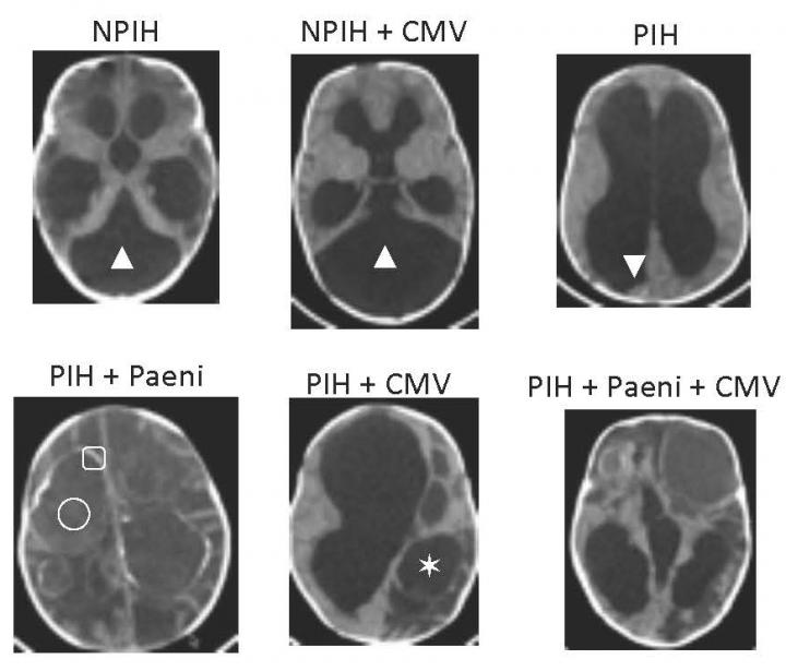 Pan-Microbial Study Implicates a Potential Culprit in a Pediatric Brain Disorder in Uganda (1 of 9)
