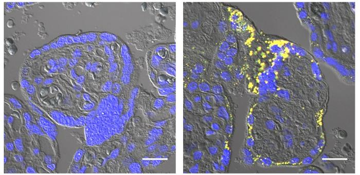 Preeclamptic placentas contain amyloid-β aggregates