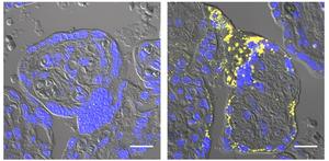 Preeclamptic placentas contain amyloid-β aggregates