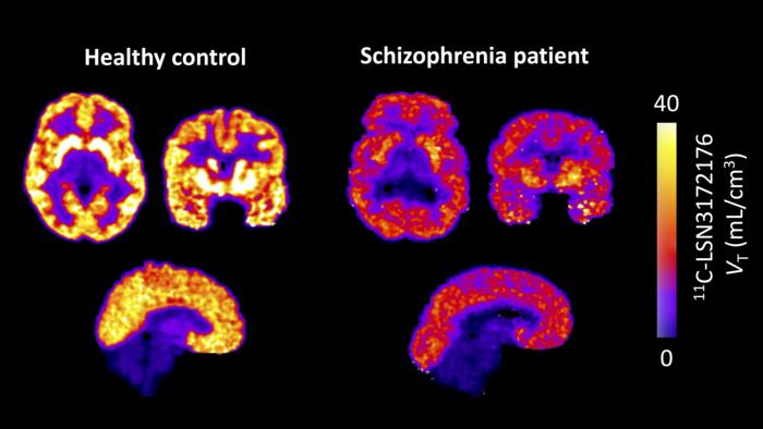 Lower Muscarinic M1 Receptor Availability in Schizophrenia: In Vivo PET Evidence