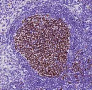Diffuse Large B Cell Lymphoma model