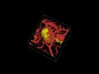 Photoacoustic Image of a Melanoma