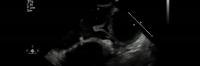 Echocardiogram testing of the tri-tube heart valve