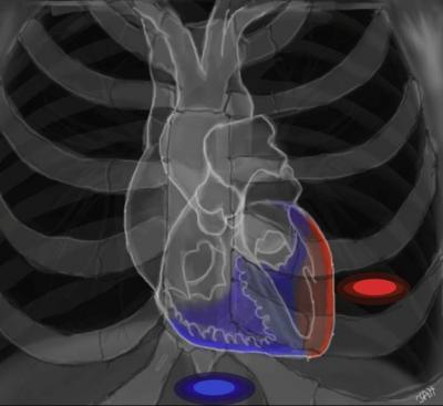 UCLA Heart Schematic