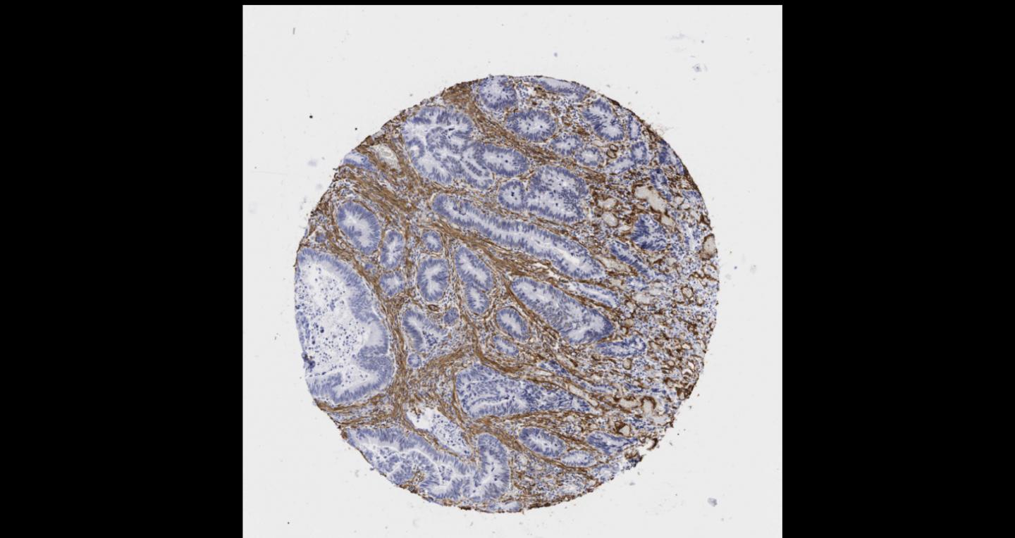 Fibroblasts Protect the Cancer Cells