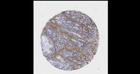 Fibroblasts Protect the Cancer Cells