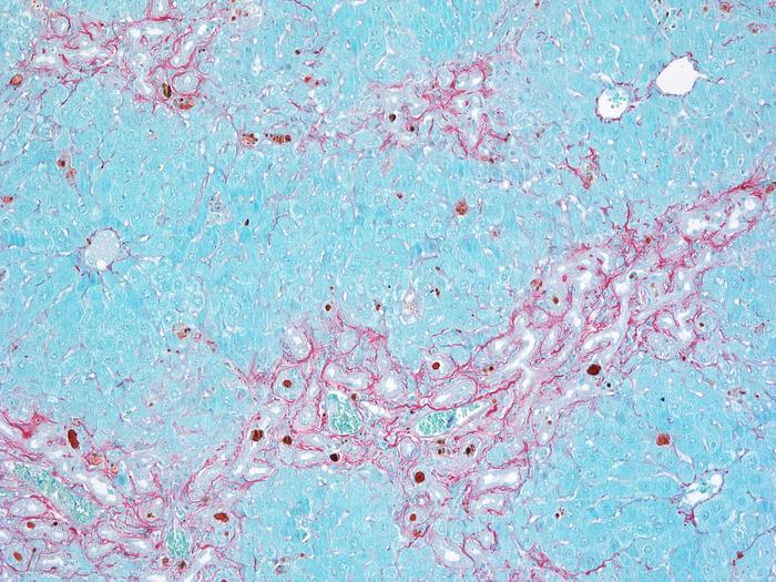 Fibrosis in parenchymal liver cells
