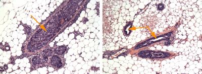 Breast Cancer Reversed