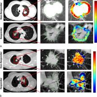 Researchers Use Radiomics to Predict Who Will Benefit from Chemotherapy