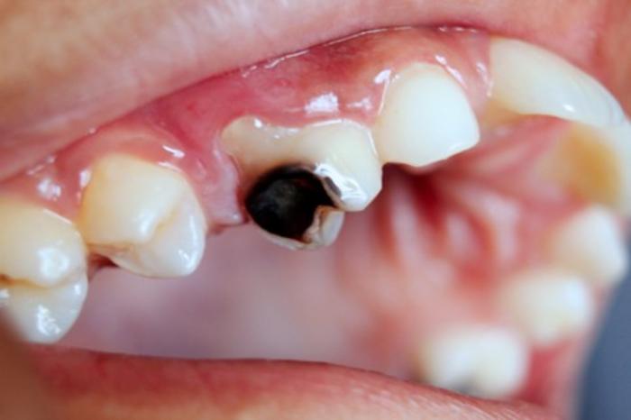 Microbial Activity in Deep Carious Lesions