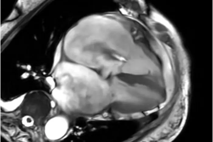 MRI Approach Improves Assessment of Common Valve Disease