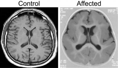 Pachygyria