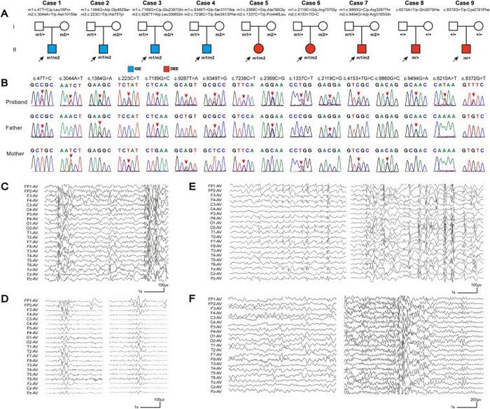 Genetic data and representative EEGs of cases with CSMD1 variants.