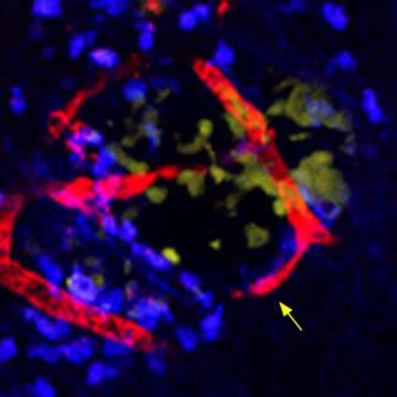 Chemotherapy Shrinks Tumors, But May Help Cancer Spread (3 of 3)