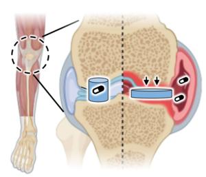 ‘Artificial cartilage’ could improve arthritis treatment