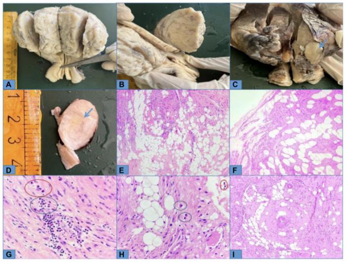 Navigating diagnostic complexity: A case report on uterine lipoleiomyoma, unveiling its benign nature amidst characteristics resembling liposarcoma
