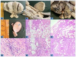 Navigating diagnostic complexity: A case report on uterine lipoleiomyoma, unveiling its benign nature amidst characteristics resembling liposarcoma