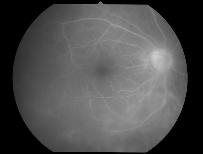Figure2. Imaging of HTLV-1 uveitis.