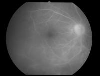 Figure2. Imaging of HTLV-1 uveitis.