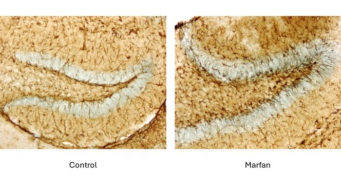 Marfan Syndrome Increases Risk of Brain Alterations